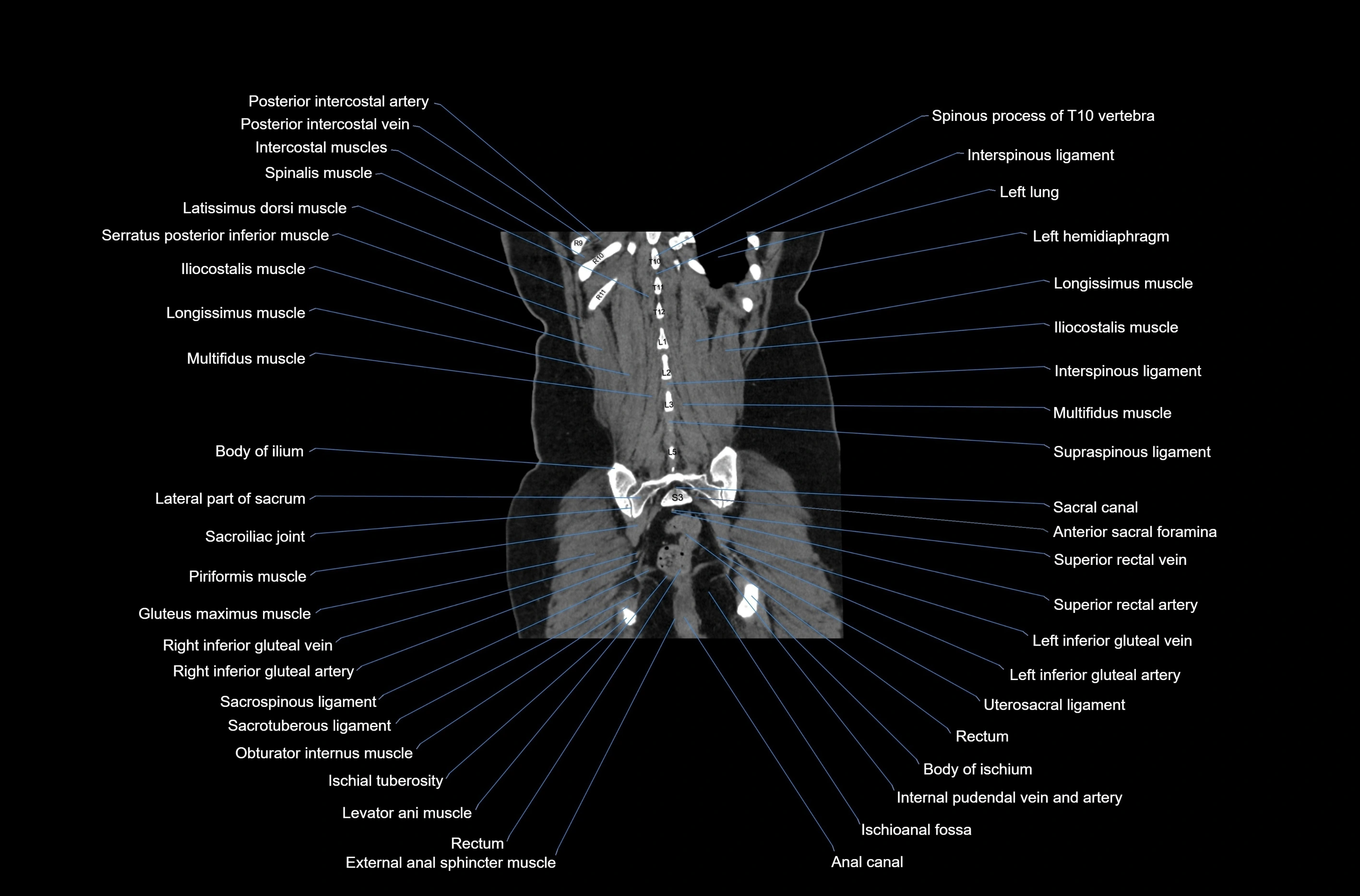 CT abdomen coronal cross sectional anatomy labelled radiology image-00072.webp